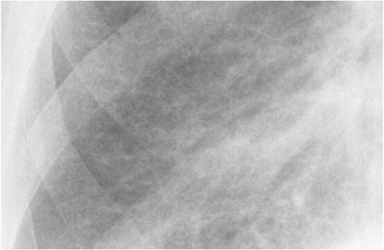 What is Asbestosis? | Causes, Symptoms, Diagnosis & Treatment